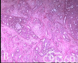 乳腺浸润性筛状癌二例