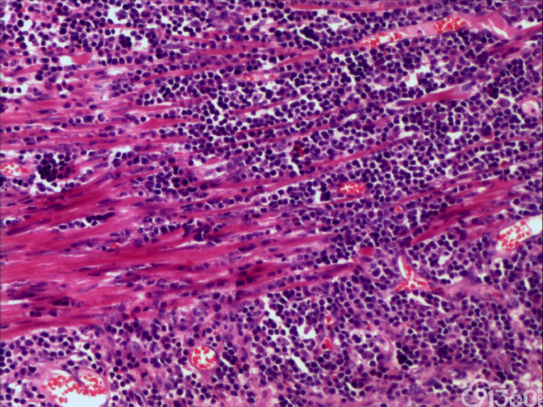 1例Ⅱ型肠相关T细胞淋巴瘤分享及疾病回顾