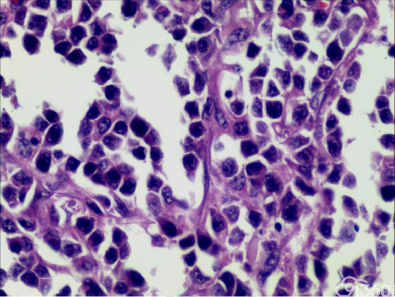 1例Ⅱ型肠相关T细胞淋巴瘤分享及疾病回顾