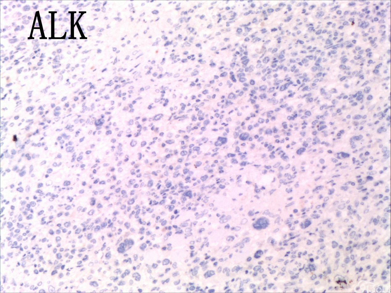外周T细胞淋巴瘤
