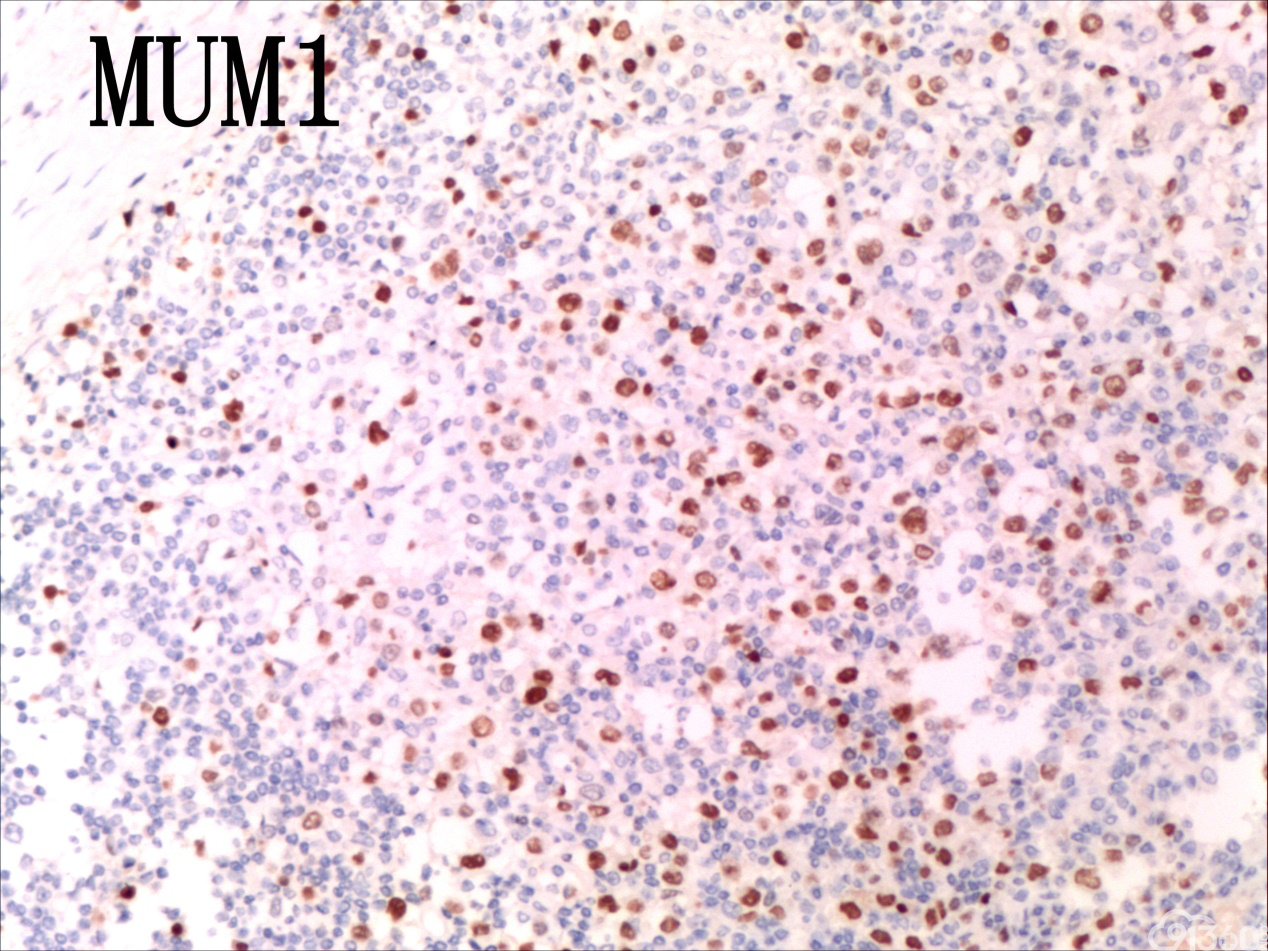 外周T细胞淋巴瘤