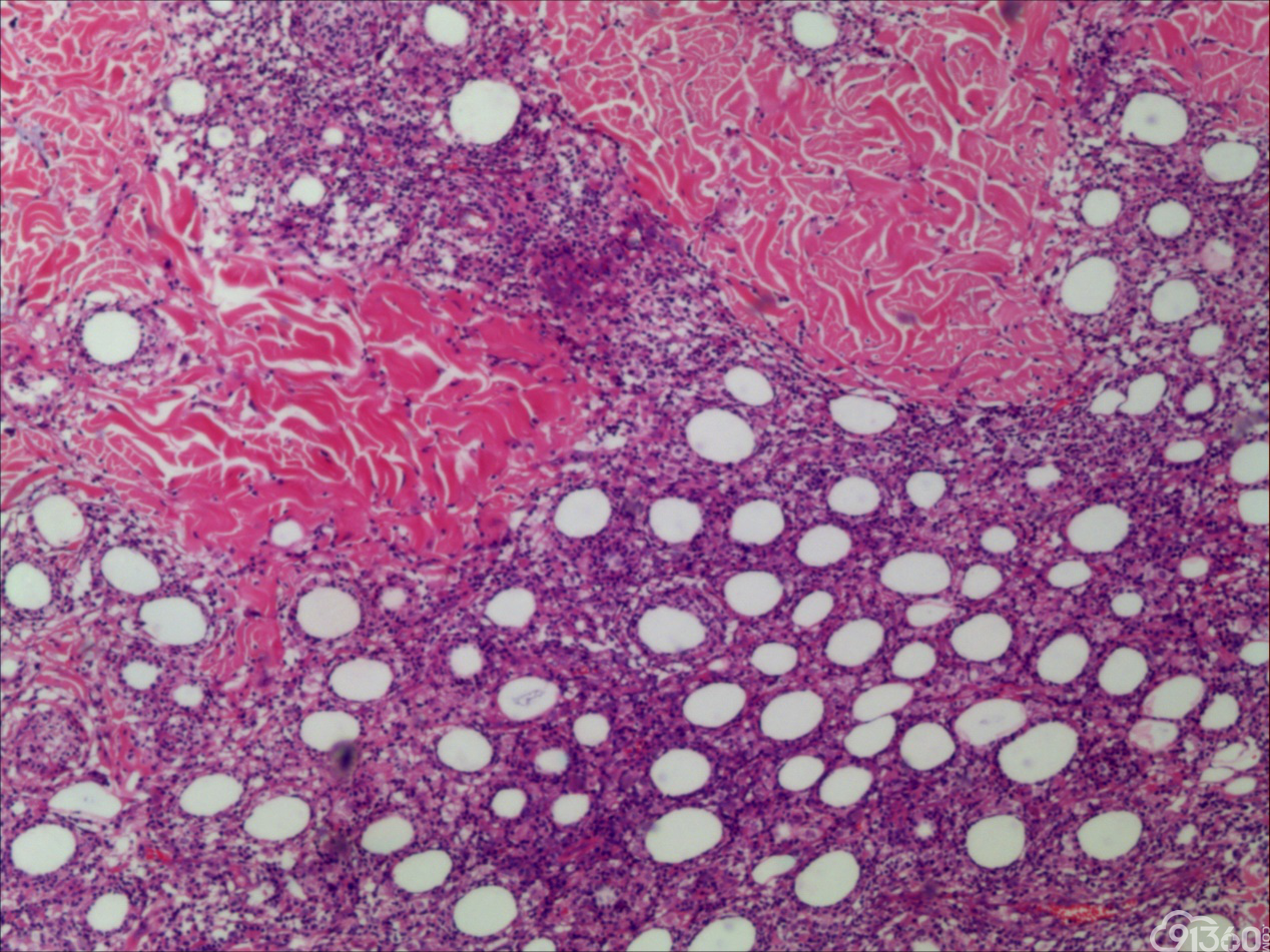 脂肪母细胞瘤