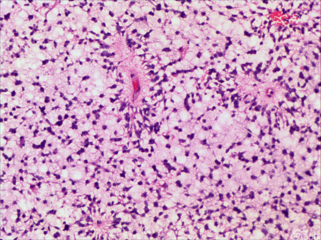 毛细胞黏液型星形细胞瘤