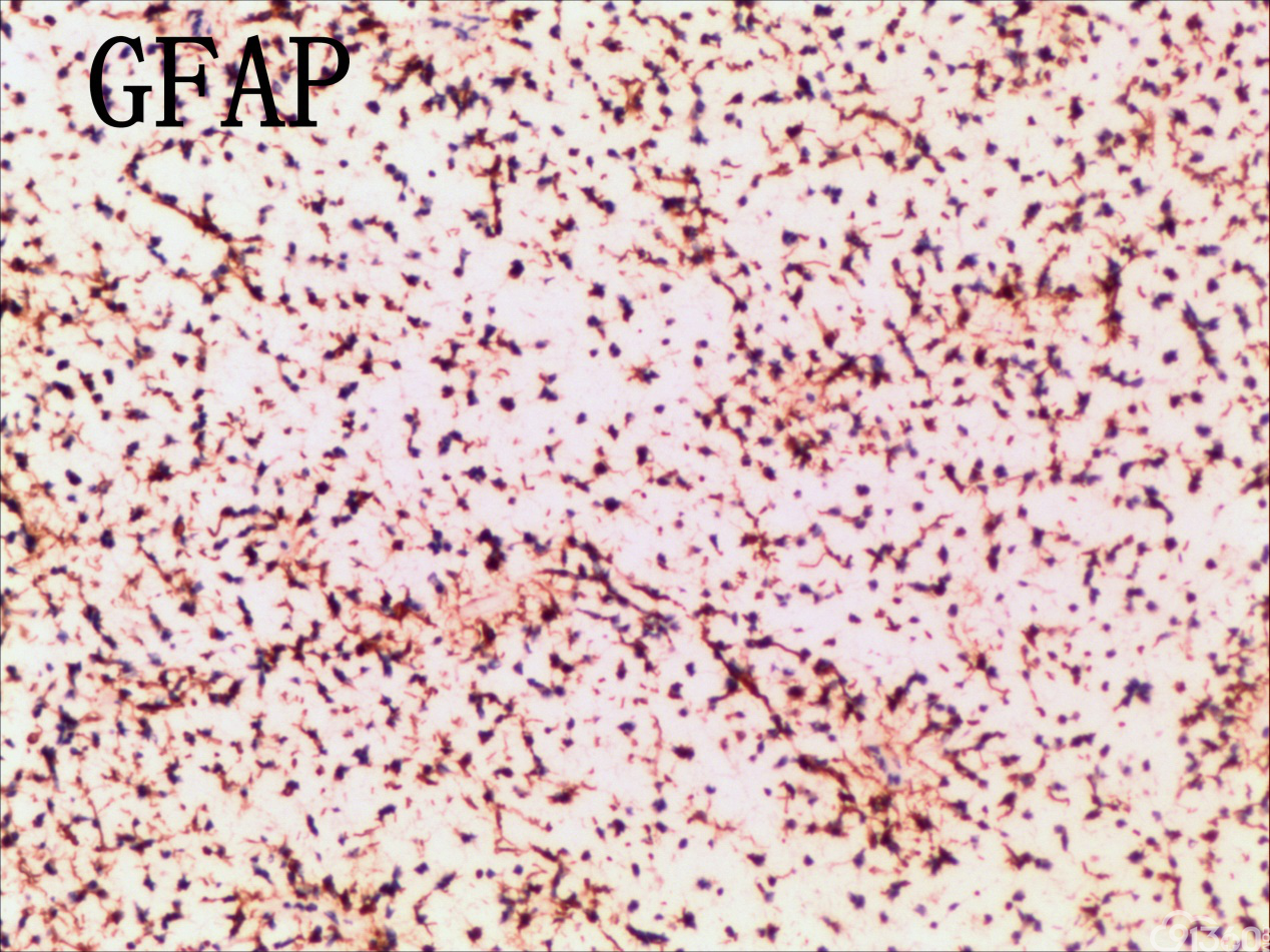 毛细胞黏液型星形细胞瘤