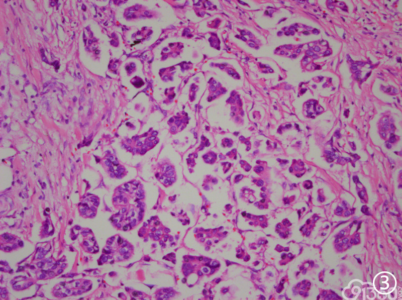 膀胱高级别浸润性尿路上皮癌伴多向分化一例