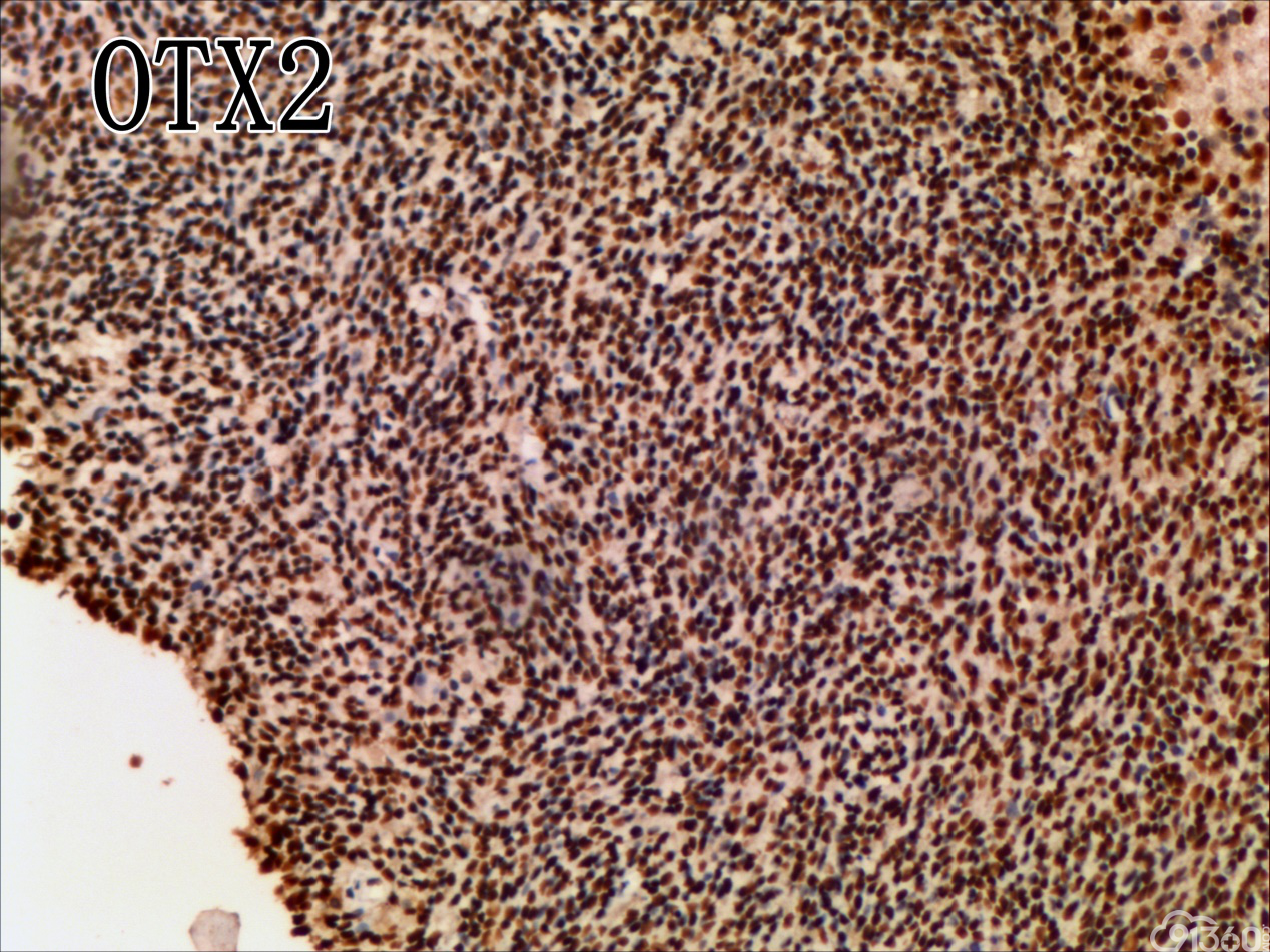 髓母细胞瘤