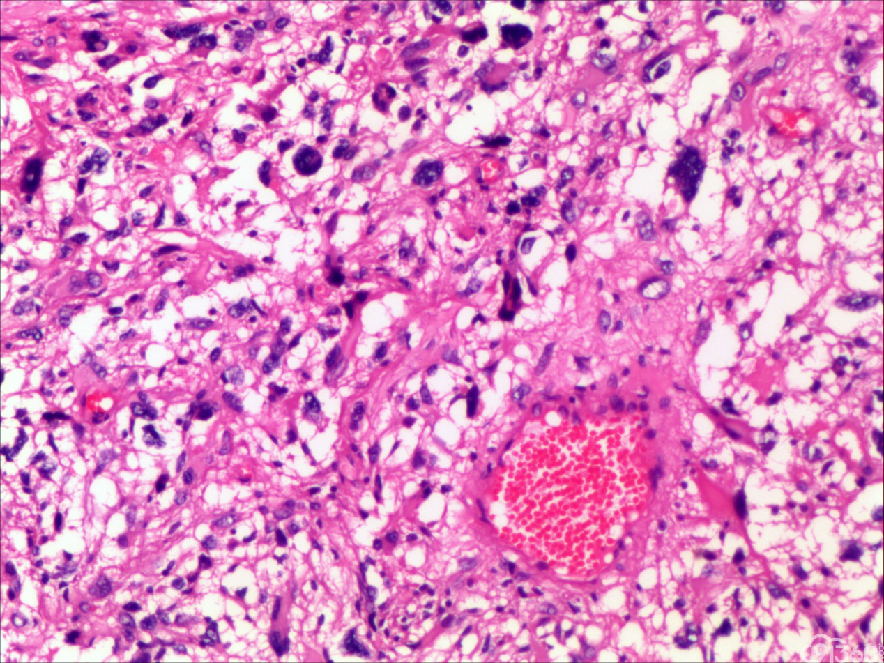 巨细胞型胶质母细胞瘤