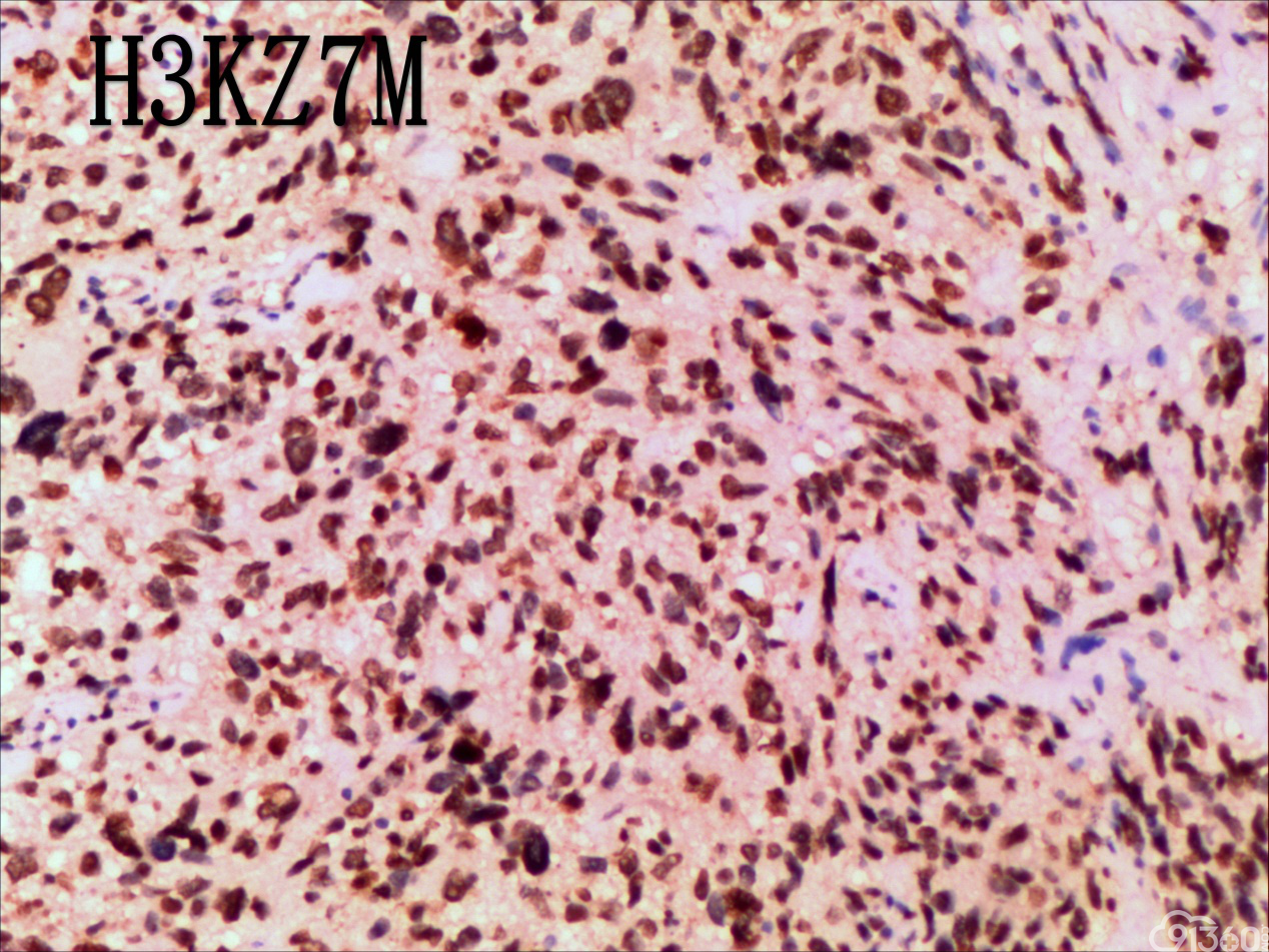 巨细胞型胶质母细胞瘤