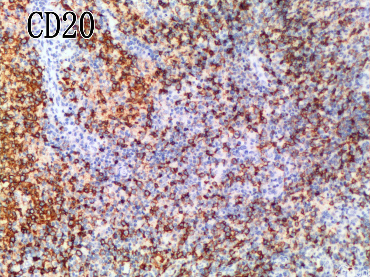 血管免疫母T细胞淋巴瘤