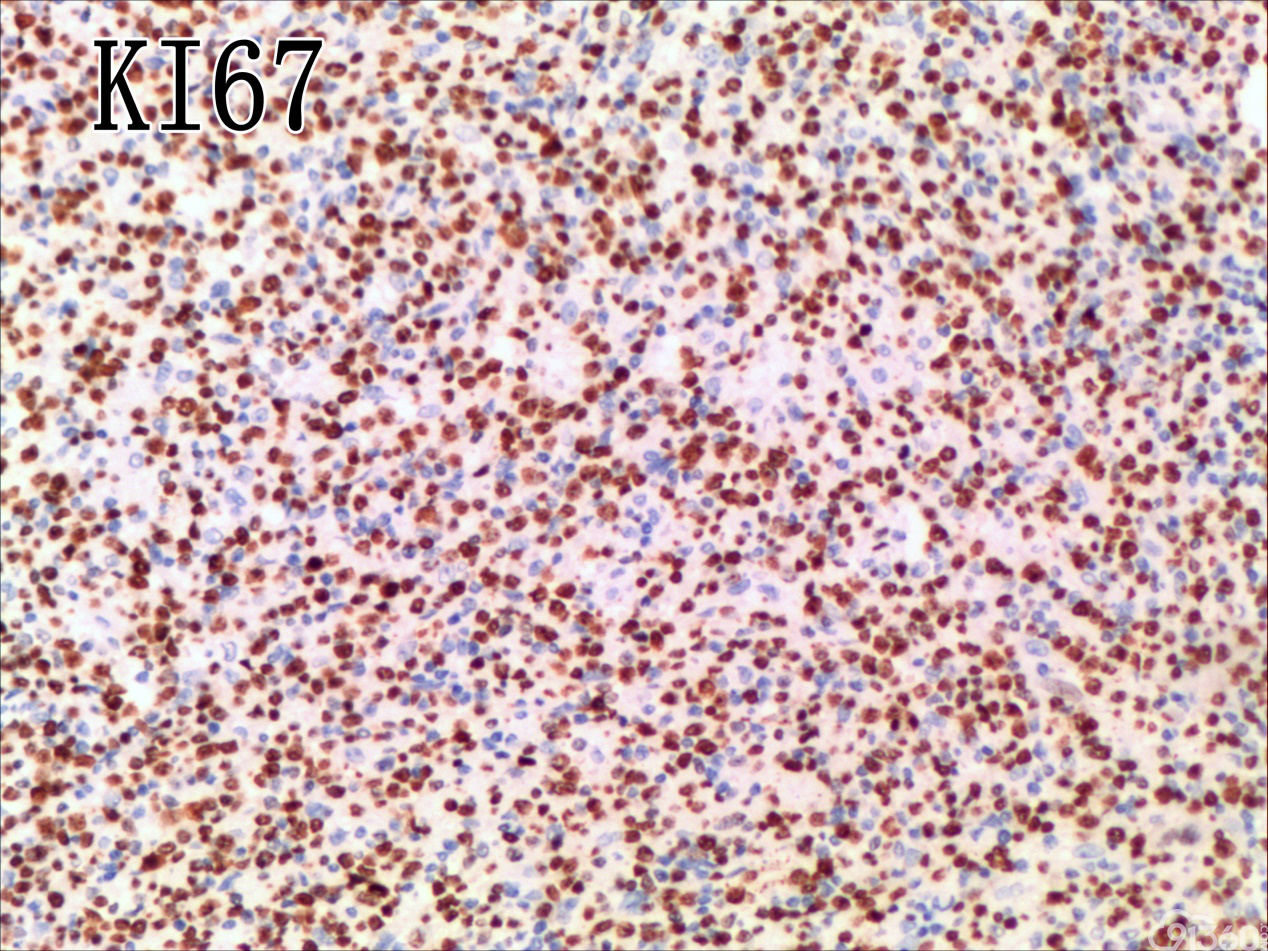 血管免疫母T细胞淋巴瘤
