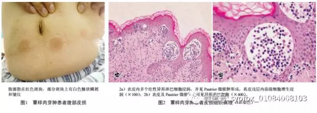 早期蕈样肉芽肿一例