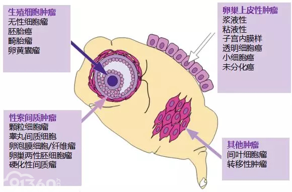 最全卵巢癌相关标记物 拿走不谢 智慧病理网