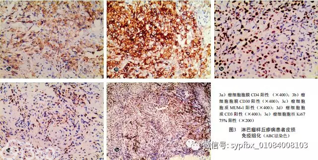 【病例报告】淋巴瘤样丘疹病一例