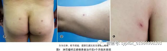 【病例报告】淋巴瘤样丘疹病一例