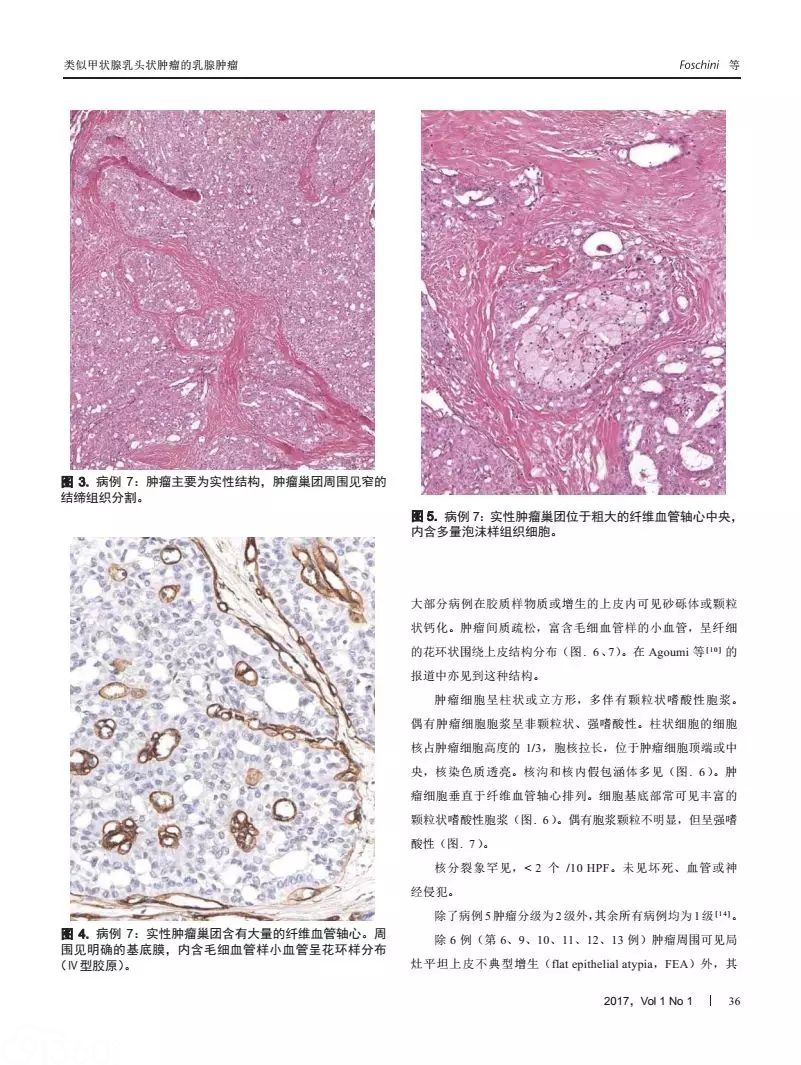 类似甲状腺高细胞亚型乳头状肿瘤的乳腺实性乳头状癌：一种独特的具有惰性生物学行为的浸润性肿瘤