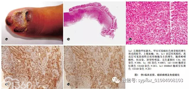 5例少见恶性黑素瘤的临床和组织病理分析