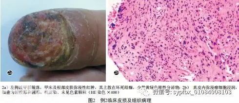 5例少见恶性黑素瘤的临床和组织病理分析