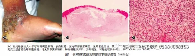 5例少见恶性黑素瘤的临床和组织病理分析