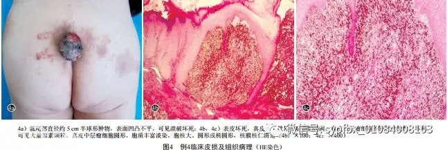 5例少见恶性黑素瘤的临床和组织病理分析