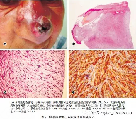 5例少见恶性黑素瘤的临床和组织病理分析