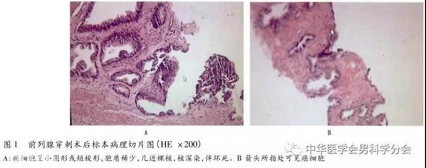 【学术】前列腺小细胞癌1例报告并文献复习