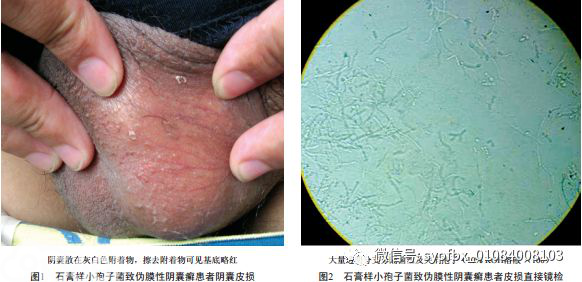 【病例报告】石膏样小孢子菌致伪膜性阴囊癣一例