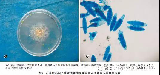 【病例报告】石膏样小孢子菌致伪膜性阴囊癣一例