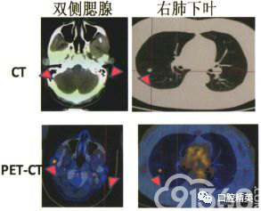 额部恶性神经鞘瘤双侧腮腺淋巴结和肺转移1例