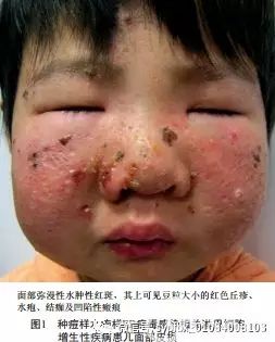 种痘样水疱样EB病毒感染相关淋巴细胞增生性疾病