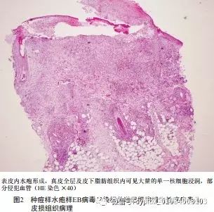 种痘样水疱样EB病毒感染相关淋巴细胞增生性疾病