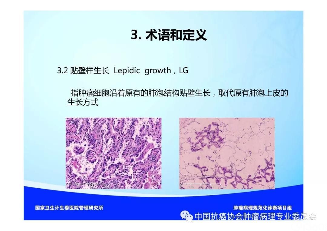 肿瘤病理规范化诊断标准 第3部分:肺癌病理诊断标准