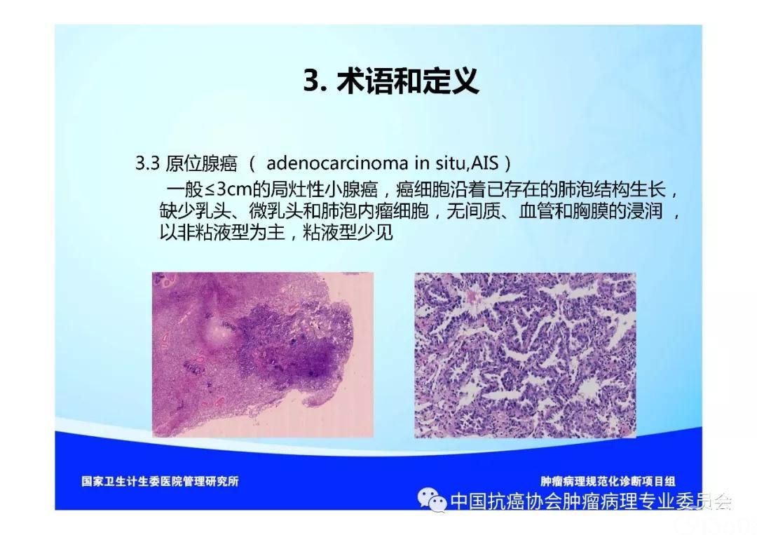 肿瘤病理规范化诊断标准 第3部分:肺癌病理诊断标准