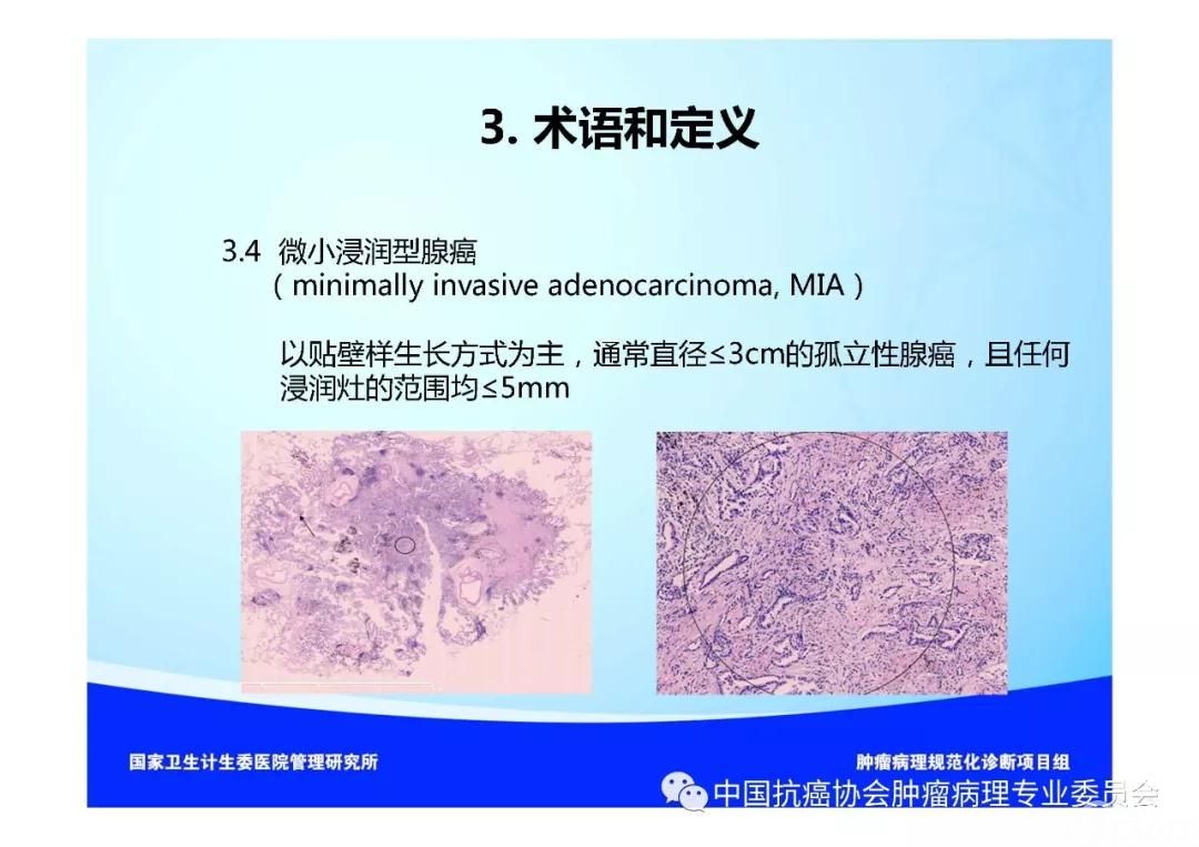 肿瘤病理规范化诊断标准 第3部分:肺癌病理诊断标准