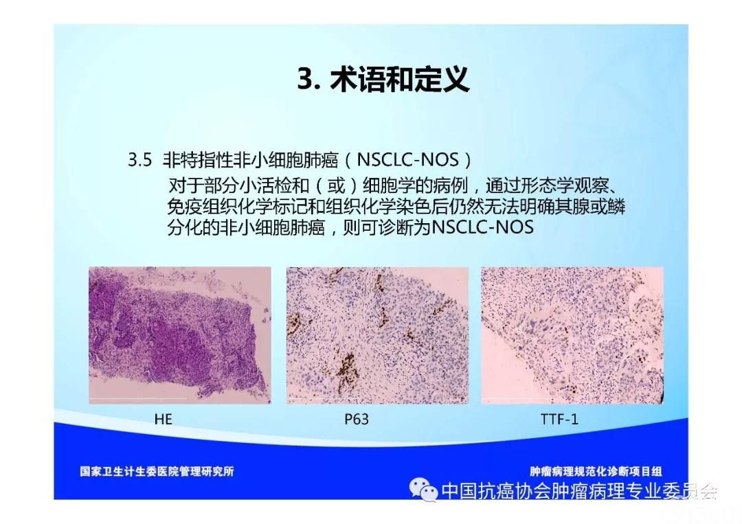 肿瘤病理规范化诊断标准 第3部分:肺癌病理诊断标准