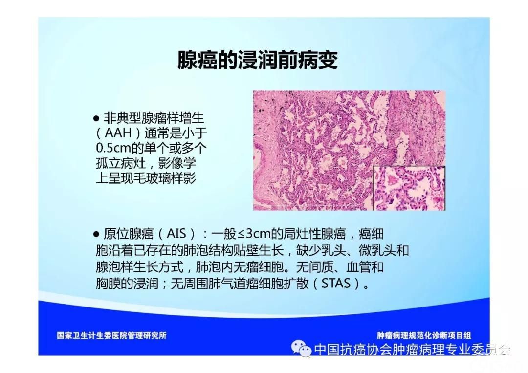 肿瘤病理规范化诊断标准 第3部分:肺癌病理诊断标准