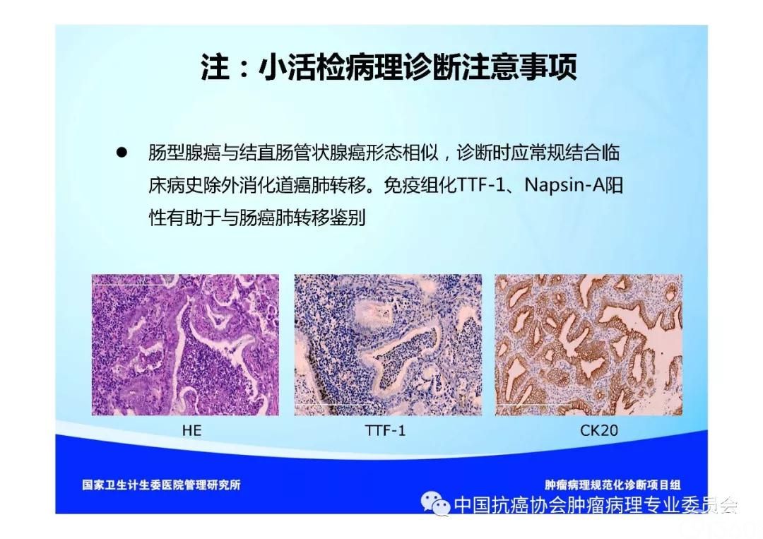 肿瘤病理规范化诊断标准 第3部分:肺癌病理诊断标准