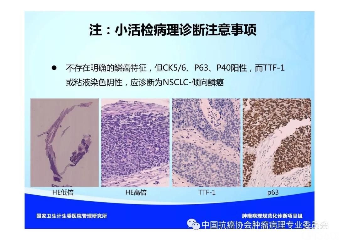 肿瘤病理规范化诊断标准 第3部分:肺癌病理诊断标准