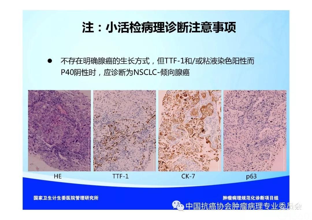 肿瘤病理规范化诊断标准 第3部分:肺癌病理诊断标准