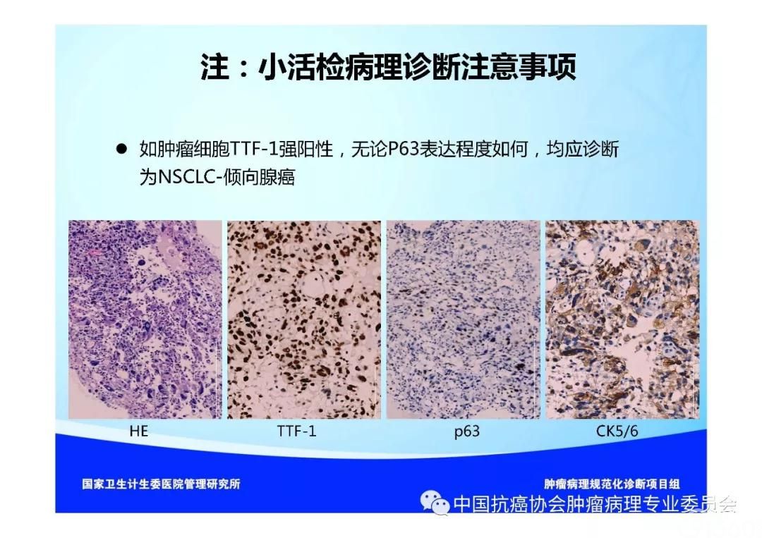 肿瘤病理规范化诊断标准 第3部分:肺癌病理诊断标准