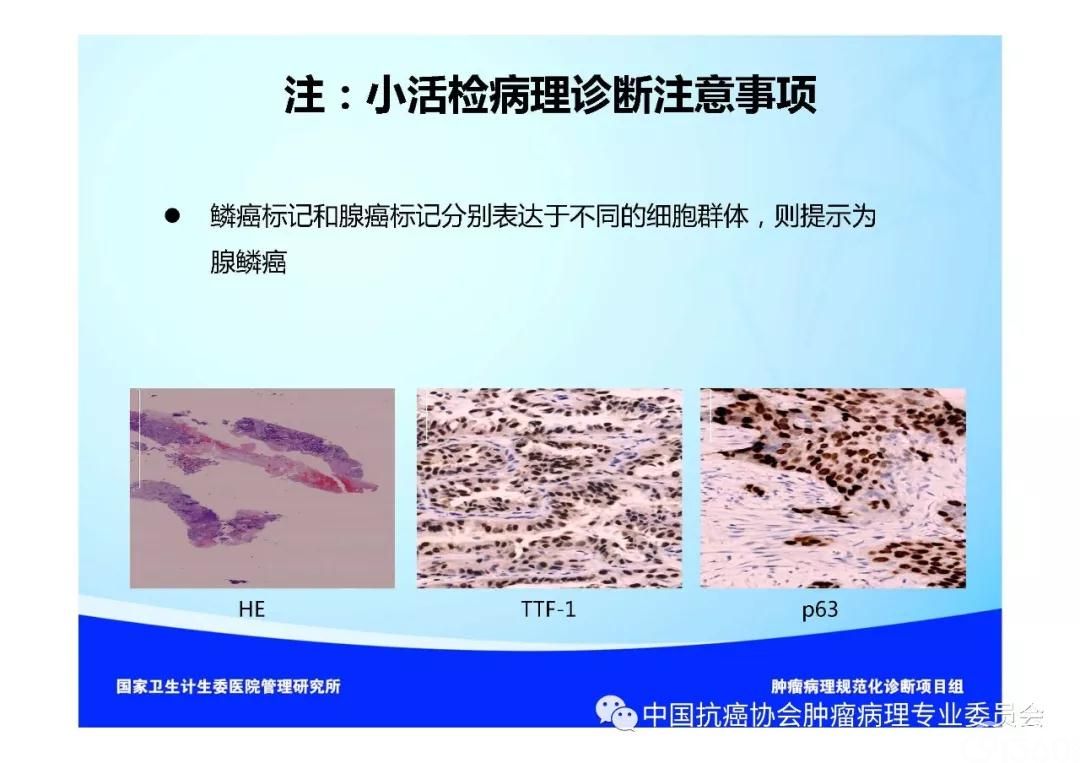 肿瘤病理规范化诊断标准 第3部分:肺癌病理诊断标准