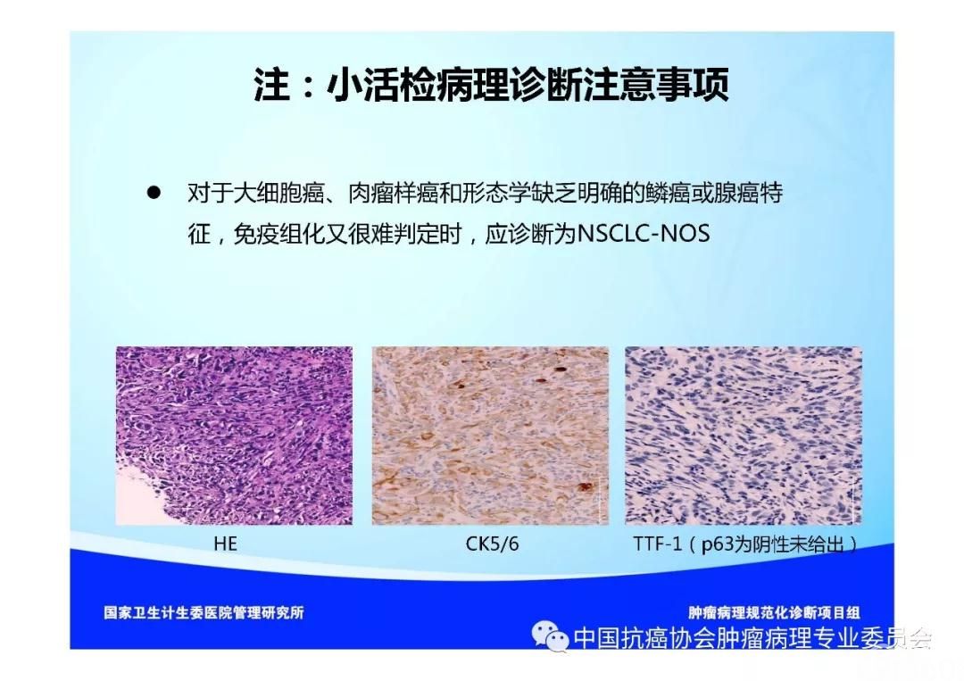 肿瘤病理规范化诊断标准 第3部分:肺癌病理诊断标准