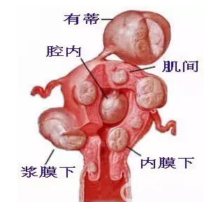 子宫肌瘤的不同位置与名称