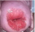 宫颈口的大片鲜红色是女性成熟的标志
