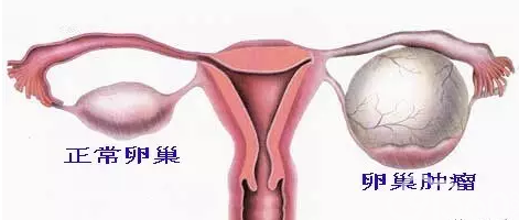 图6 卵巢肿瘤与正常卵巢比较