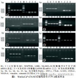 Wnt5a-Ca2+-CN-NFAT通路信号分子在黑素瘤中的表达