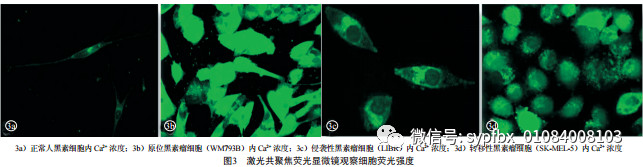 Wnt5a-Ca2+-CN-NFAT通路信号分子在黑素瘤中的表达