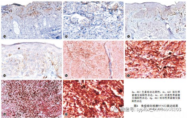 Wnt5a-Ca2+-CN-NFAT通路信号分子在黑素瘤中的表达