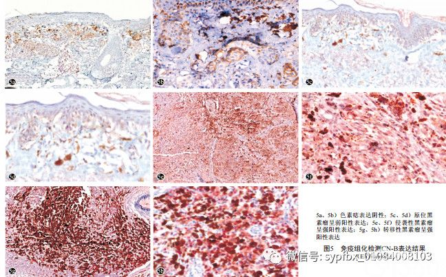 Wnt5a-Ca2+-CN-NFAT通路信号分子在黑素瘤中的表达