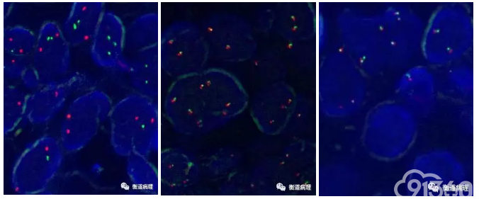 弥漫性大B细胞淋巴瘤(2017版WHO更新要点及间变变型简述)