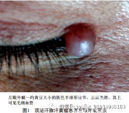 【病例报告】顶泌汗腺汗囊瘤一例